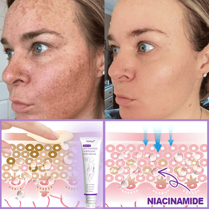 30% OFF✨✨ Vitalisys® PDRN Multi-Peptide Massaging Body Roller Cream- Anti-aging, Hydrating, Skin Firming & Lifting, Skin Repair, Even Tone, Acne and Dark Spot Treatment, Wart and Mole Removal, and Psoriasis Relief