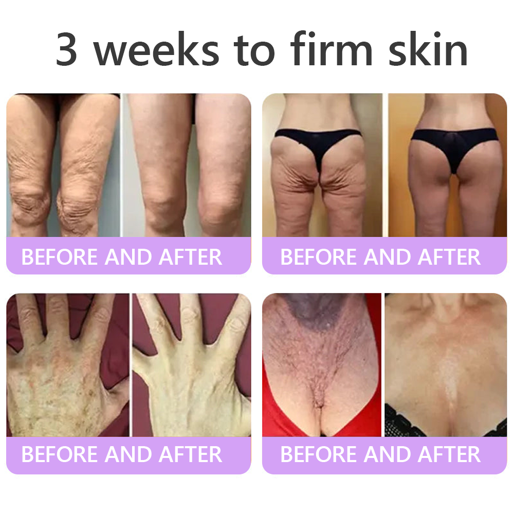 30% OFF✨✨ Vitalisys® PDRN Multi-Peptide Massaging Body Roller Cream- Anti-aging, Hydrating, Skin Firming & Lifting, Skin Repair, Even Tone, Acne and Dark Spot Treatment, Wart and Mole Removal, and Psoriasis Relief