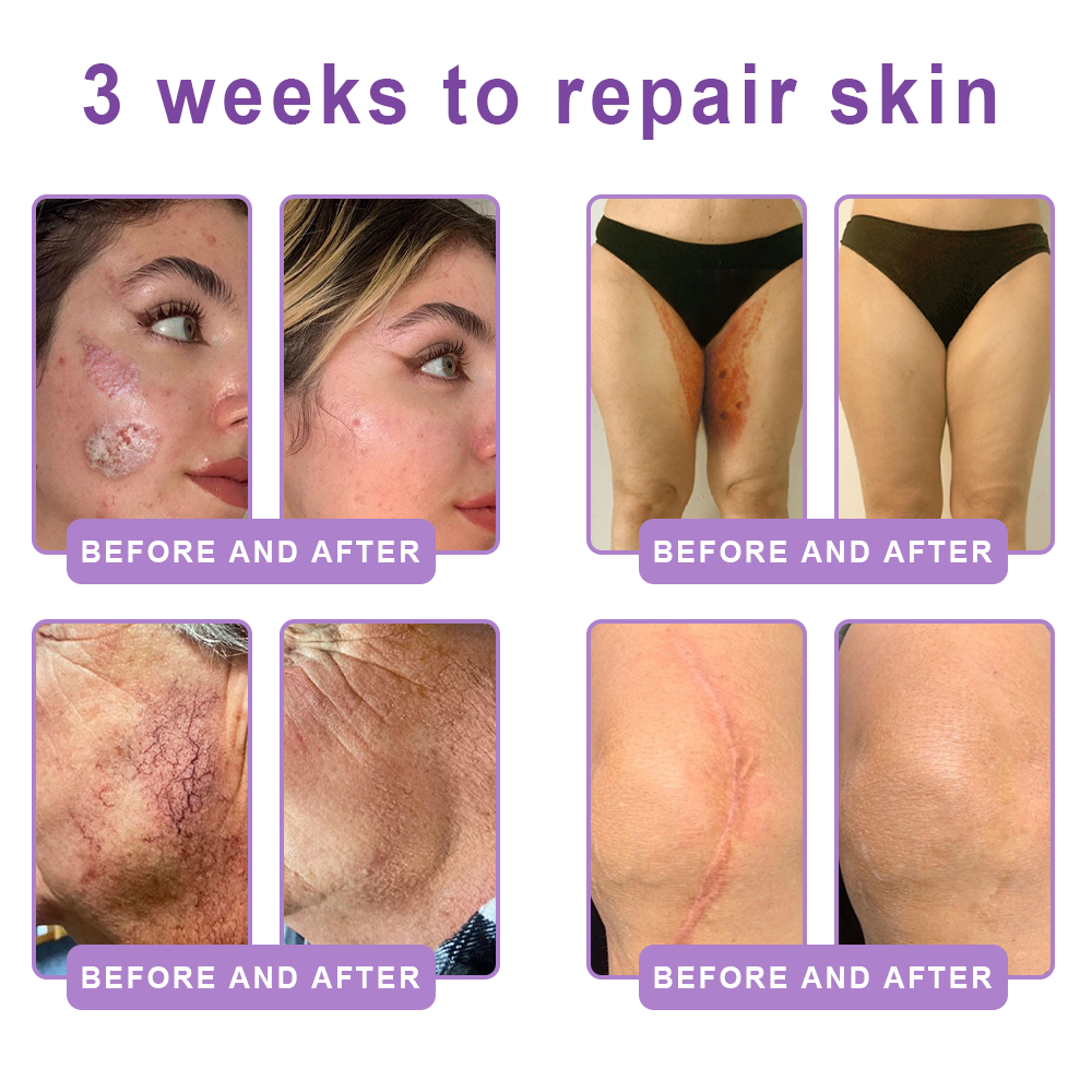 30% OFF✨✨ Vitalisys® PDRN Multi-Peptide Massaging Body Roller Cream- Anti-aging, Hydrating, Skin Firming & Lifting, Skin Repair, Even Tone, Acne and Dark Spot Treatment, Wart and Mole Removal, and Psoriasis Relief